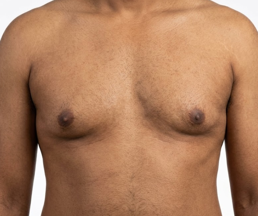 Gynecomastia After Weight Loss in Surat at Elegance Clinic