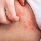 Inner Thigh Chafing