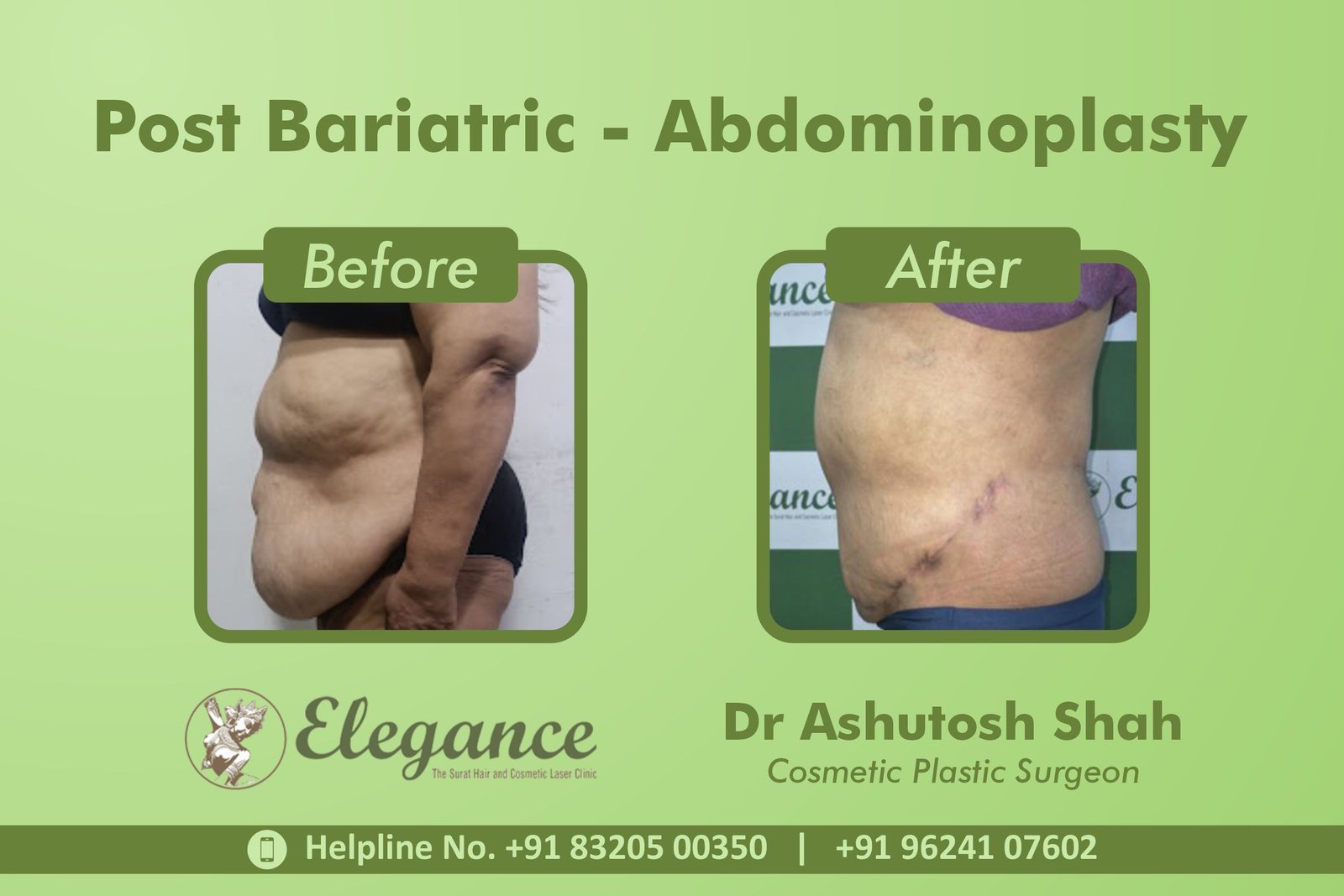 Tummy Tuck before and after results at Elegance Clinic Surat