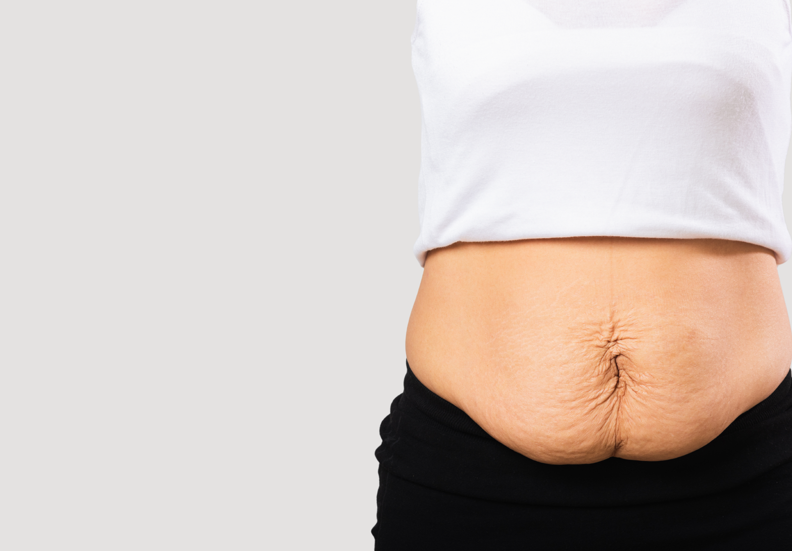 Post bariatric body contouring patient at Elegance Clinic Surat