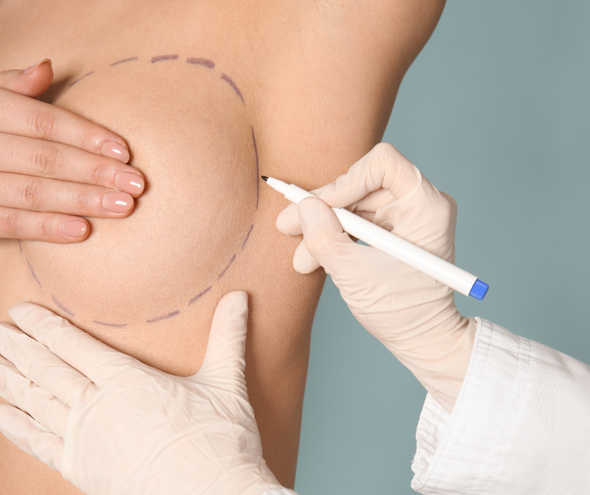Auto-Augmentation Mastopexy in Surat at Elegance Clinic