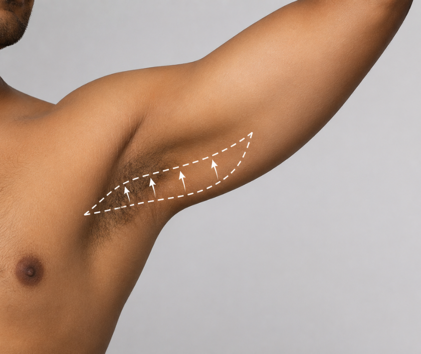 Axillary Lift in Surat at Elegance Clinic