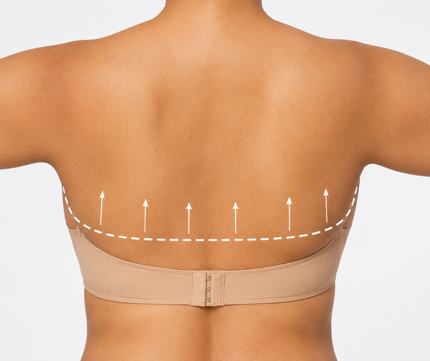 Bra-Line Back Lift in Surat at Elegance Clinic