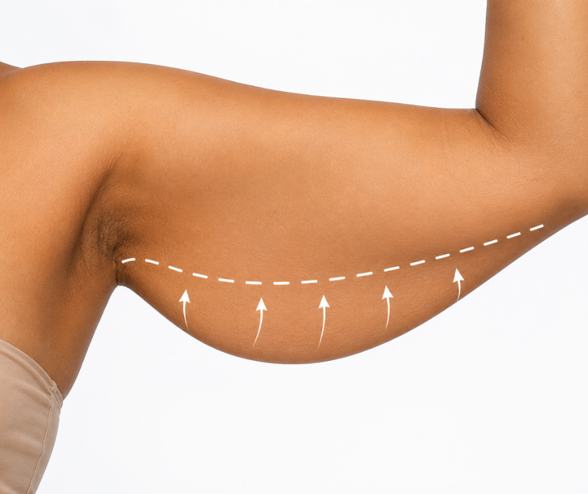 Arms, Thighs & Legs in Surat at Elegance Clinic