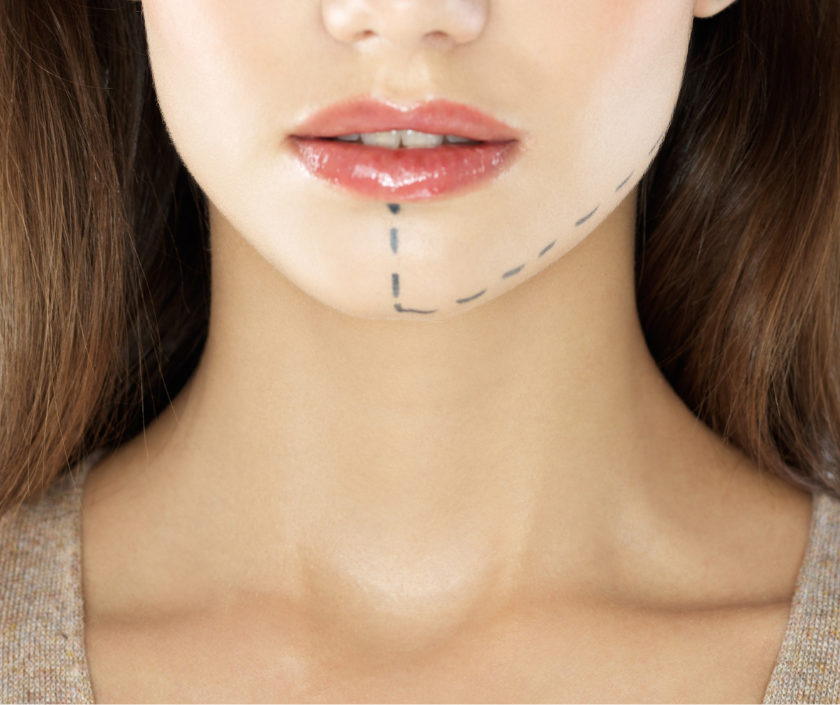 Chin Augmentation & Facial Implants in Surat at Elegance Clinic
