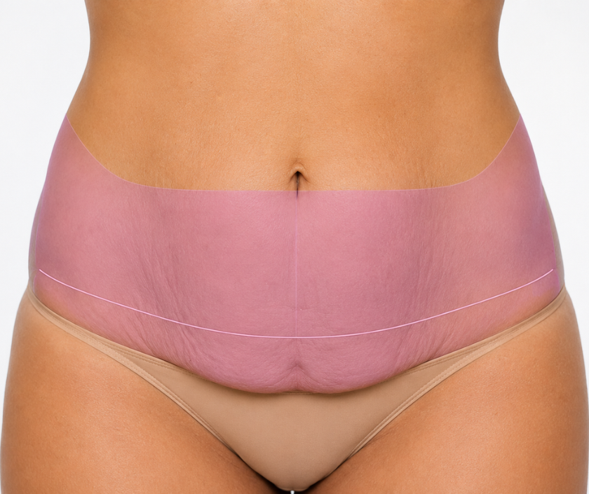 Extended Tummy Tuck in Surat at Elegance Clinic