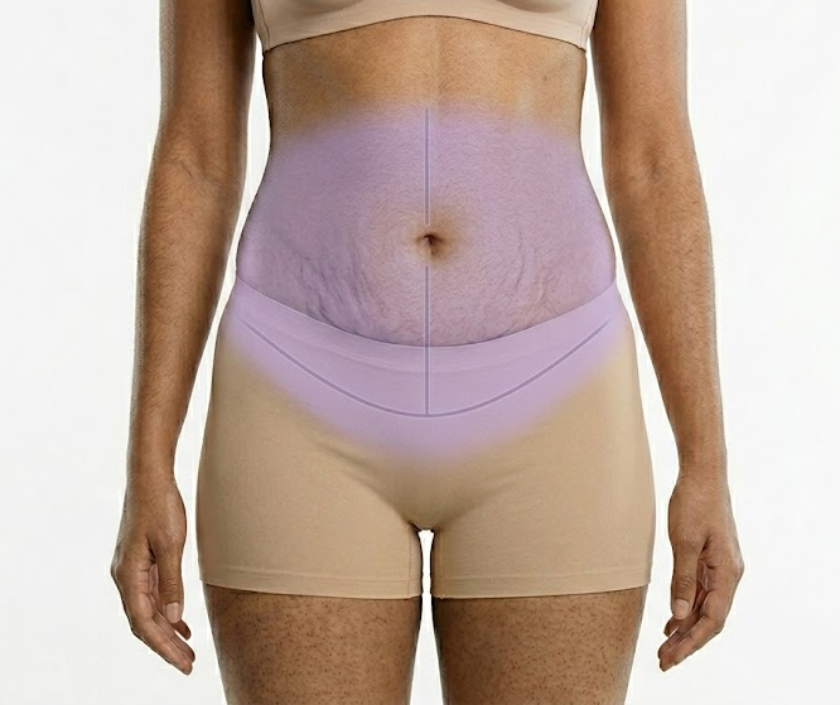 Fleur-de-Lis Tummy Tuck in Surat at Elegance Clinic