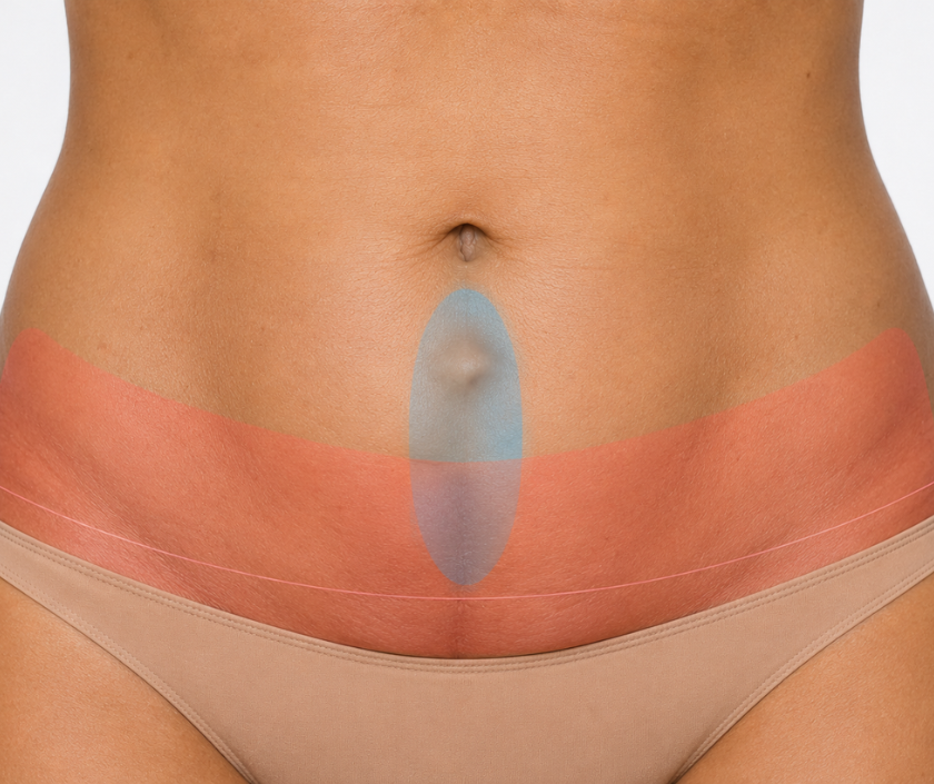 Hernia Repair with Tummy Tuck in Surat at Elegance Clinic