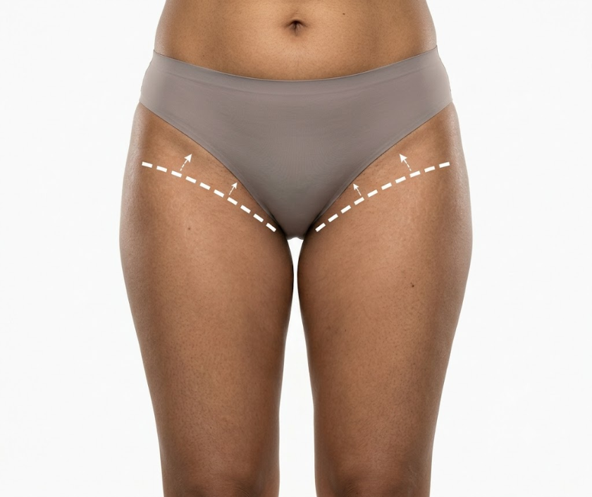 Horizontal Thigh Lift in Surat at Elegance Clinic