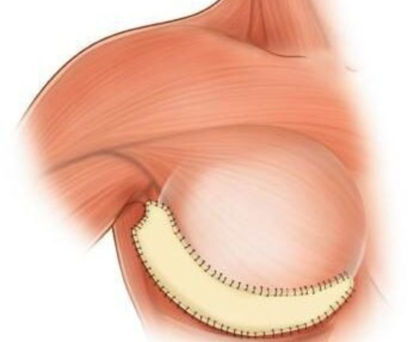 Internal Mesh Support in Surat at Elegance Clinic