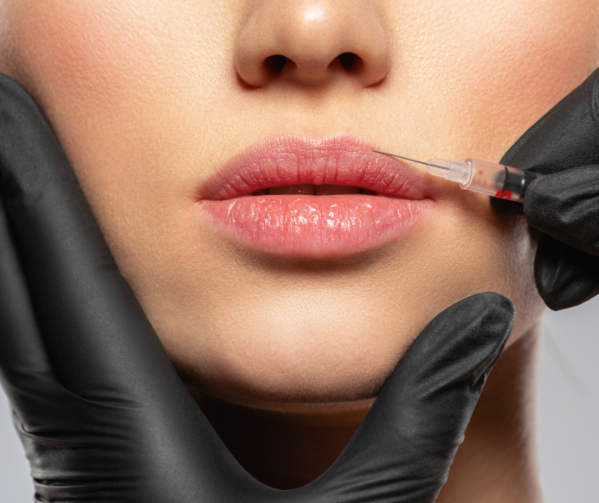 Lip Lift in Surat at Elegance Clinic