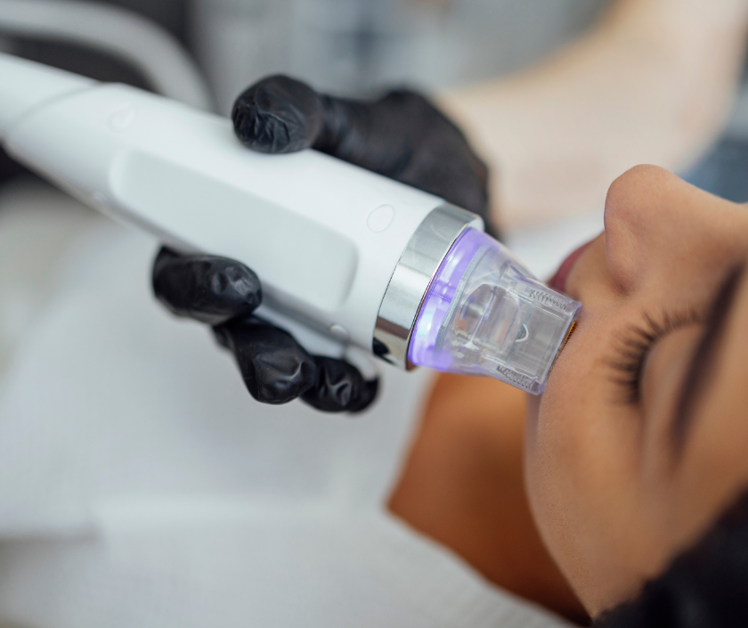 Microneedling RF in Surat at Elegance Clinic