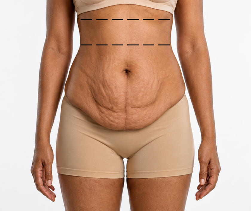 Reverse Tummy Tuck in Surat at Elegance Clinic