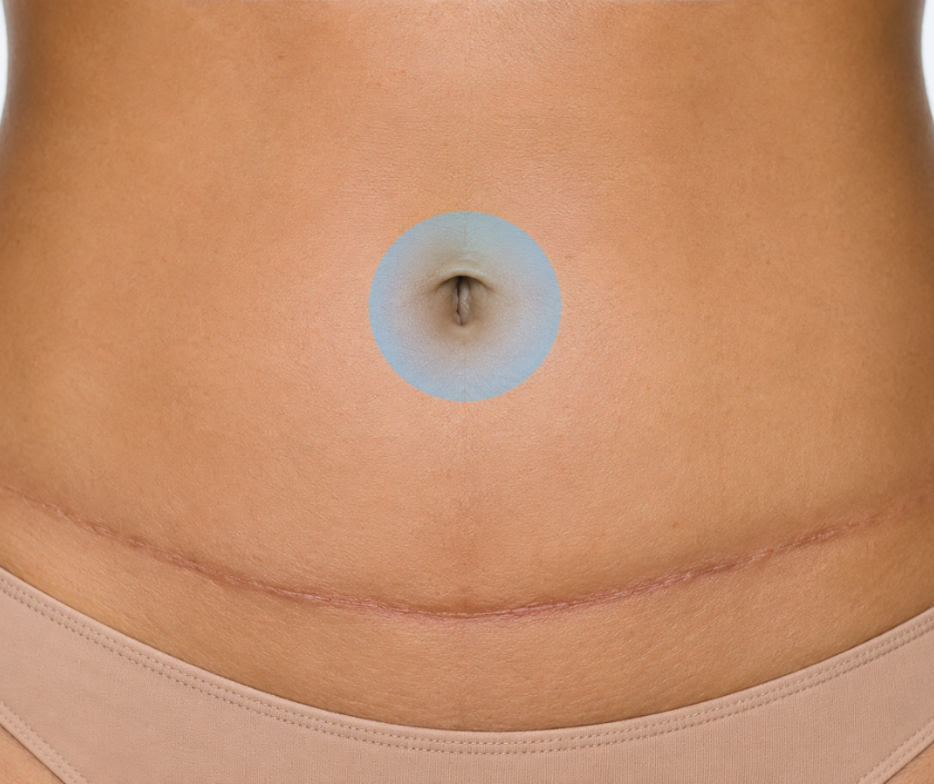 Umbilical Reconstruction in Surat at Elegance Clinic