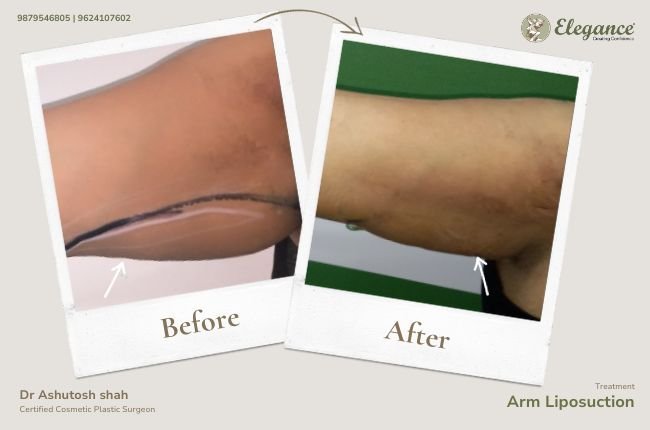 Arm Lift before and after results at Elegance Clinic Surat