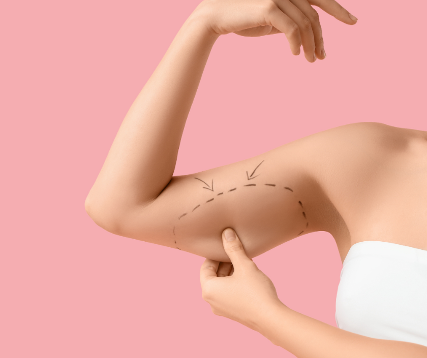 Brachioplasty arm lift surgery at Elegance Clinic Surat