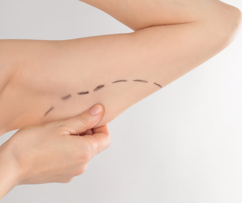 Extended brachioplasty for arm and side chest skin removal