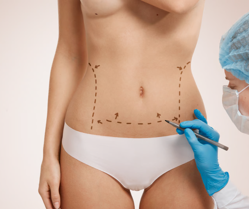 Lower body lift surgery after massive weight loss at Elegance Clinic