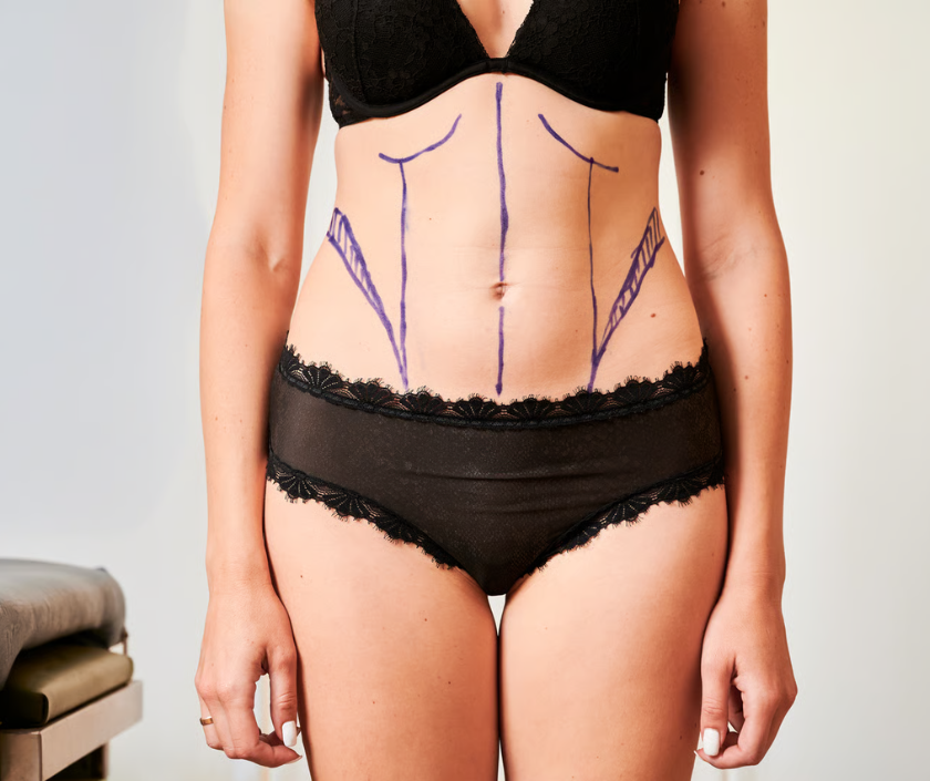 Reverse tummy tuck for upper abdomen contouring at Elegance Clinic