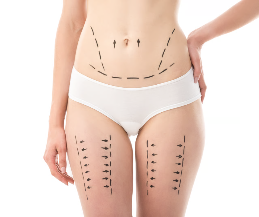Vertical thigh lift for severe inner thigh laxity at Elegance Clinic